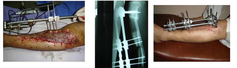 Manejo de las fracturas expuestas la pérdida de un segmento óseo